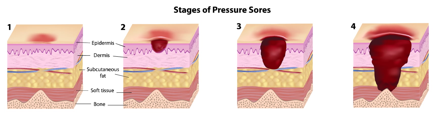 What Can I Use For A Pressure Sore